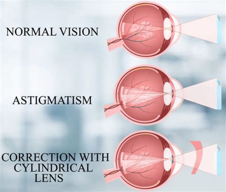 Unveiling The Secrets Of Astigmatism: A Journey Of Clarity